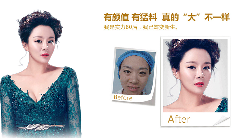 新竹脂肪移植、隆鼻