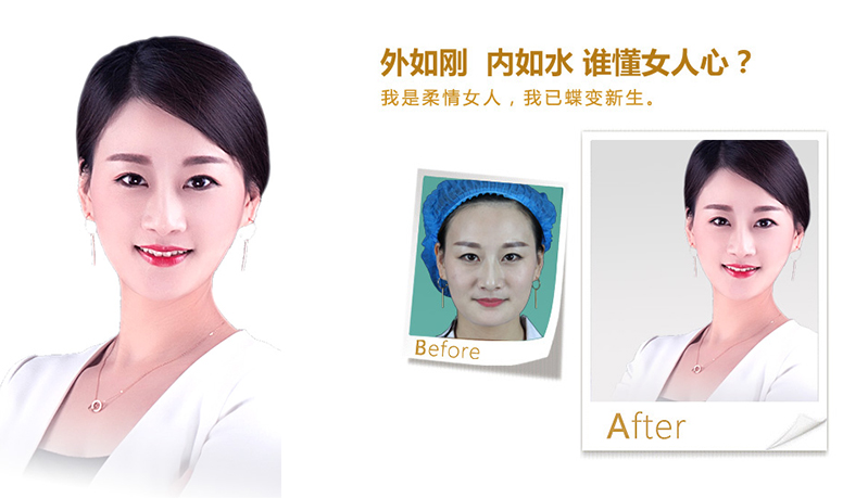 新竹V脸、线雕隆鼻